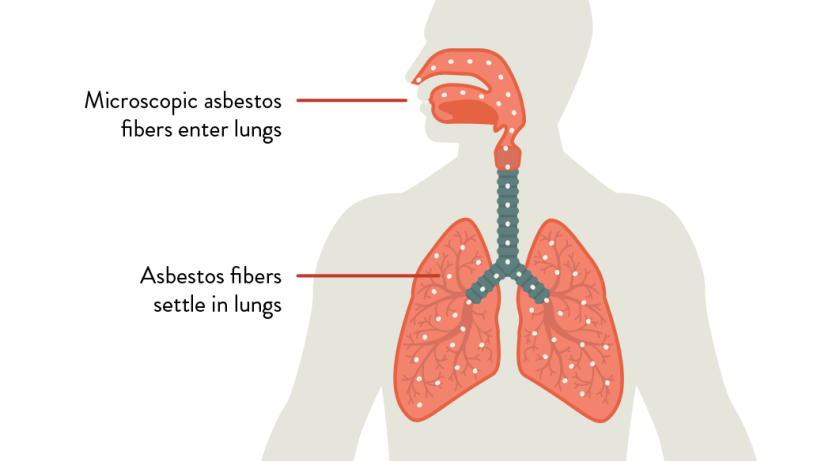 Asbestosis Causing Danger Zones at Home and At Work